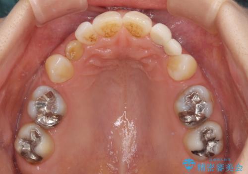 欠損の多い歯列 部分矯正とセラミックブリッジで自然な見た目にの治療前