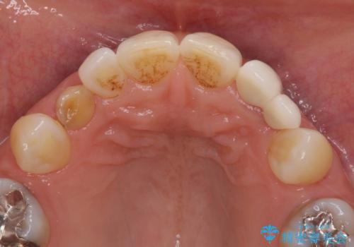 欠損の多い歯列 部分矯正とセラミックブリッジで自然な見た目にの治療前