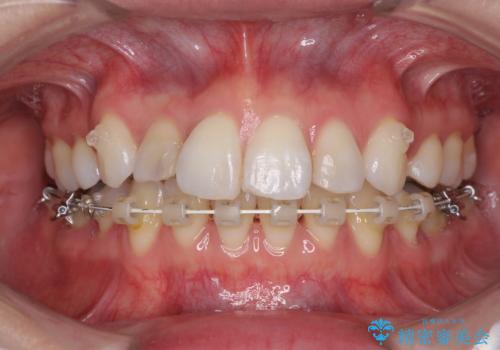 目立たないハーフリンガル矯正 抜歯矯正で口元を改善の治療中