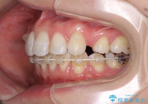 目立たないハーフリンガル矯正 抜歯矯正で口元を改善の治療中