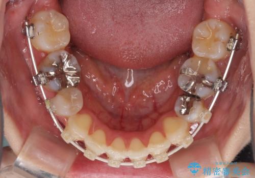 目立たないハーフリンガル矯正 抜歯矯正で口元を改善の治療中