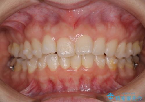 invisalign治療中のメンテナンスの治療前