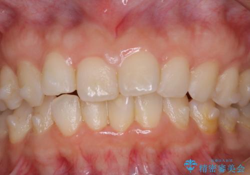 invisalign治療中のメンテナンスの治療前