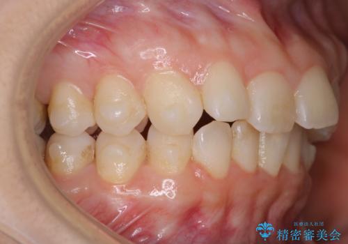 invisalign治療中のメンテナンスの症例 治療前