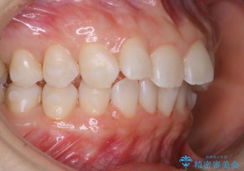 invisalign治療中のメンテナンスの症例 治療後