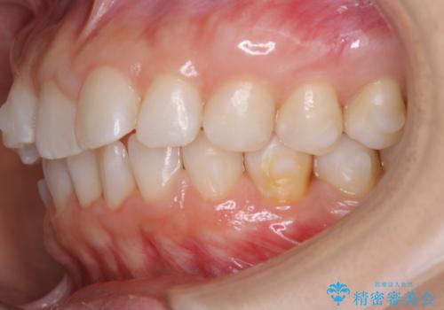 invisalign治療中のメンテナンスの治療後