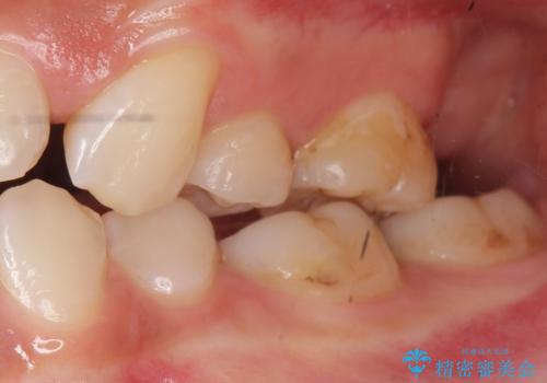 奥歯が黒い セラミッククラウンで綺麗に 30代女性の治療前