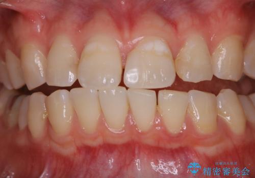 インビザラインで矯正治療を始める前にクリーニングの治療前