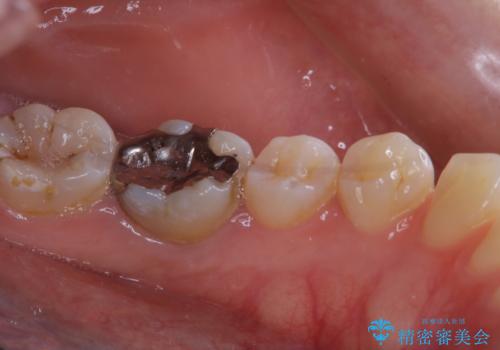 インビザラインで矯正治療を始める前にクリーニングの治療前