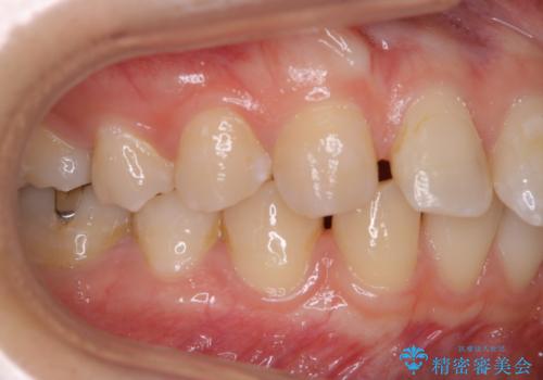 インビザラインで矯正治療を始める前にクリーニングの治療前