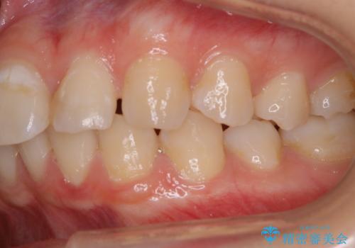インビザラインで矯正治療を始める前にクリーニングの治療前