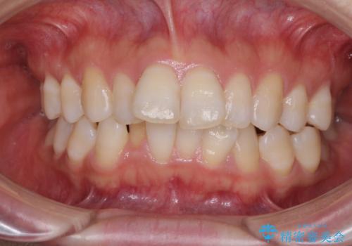 インビザラインが続けられない　ワイヤー装置による抜歯矯正の症例 治療前