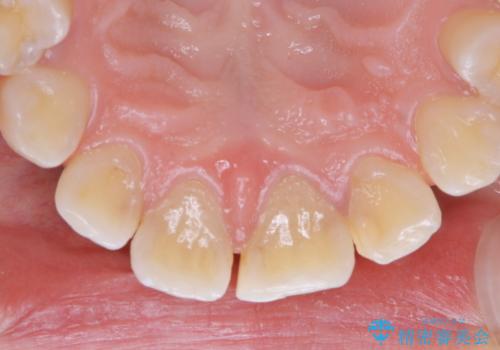 インビザラインで矯正治療を始める前にクリーニングの治療前