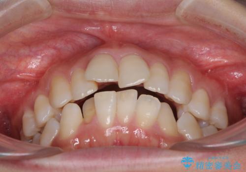 インビザラインが続けられない ワイヤー装置による抜歯矯正の治療前