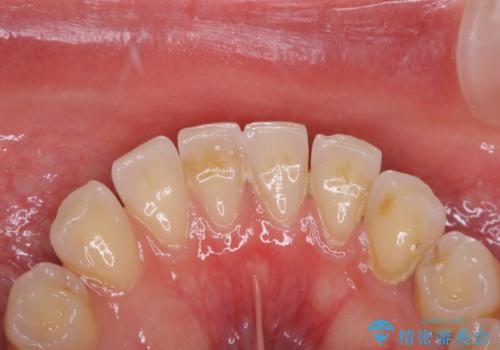 インビザラインで矯正治療を始める前にクリーニングの治療前