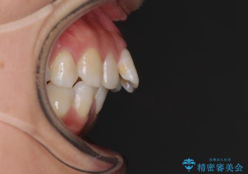 インビザラインが続けられない ワイヤー装置による抜歯矯正の治療前