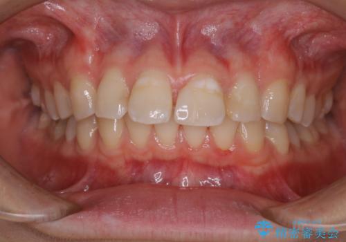 インビザラインで矯正治療を始める前にクリーニングの治療後