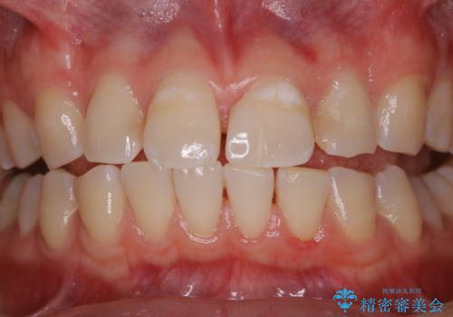 インビザラインで矯正治療を始める前にクリーニングの治療後