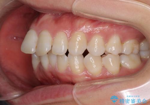 インビザラインが続けられない ワイヤー装置による抜歯矯正の治療前