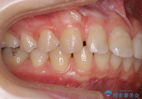 インビザラインで矯正治療を始める前にクリーニングの治療後