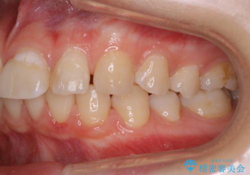 インビザラインで矯正治療を始める前にクリーニングの治療後