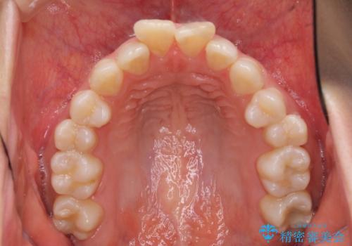 インビザラインが続けられない ワイヤー装置による抜歯矯正の治療前