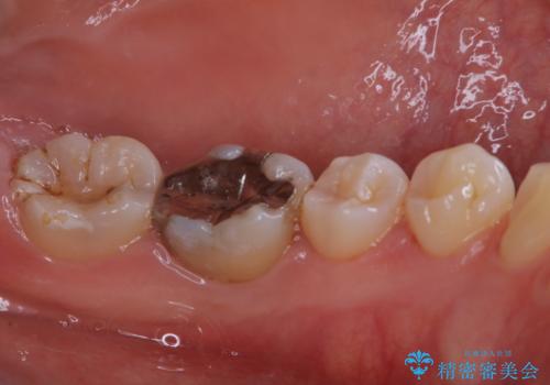 インビザラインで矯正治療を始める前にクリーニングの治療後