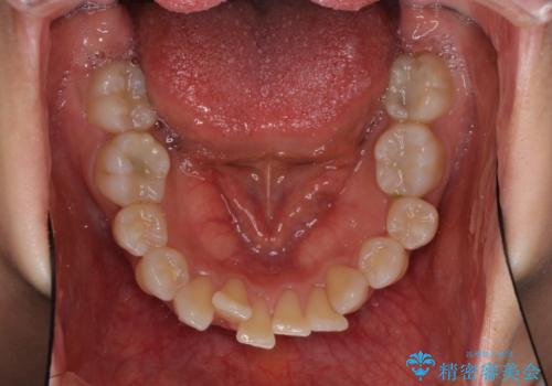 インビザラインが続けられない ワイヤー装置による抜歯矯正の治療前