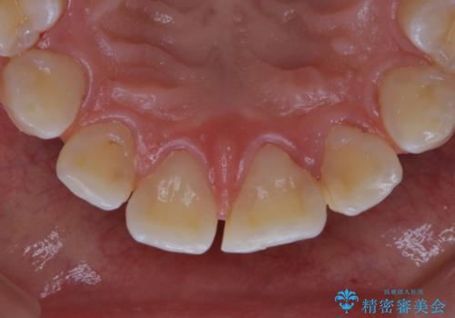 インビザラインで矯正治療を始める前にクリーニングの治療後