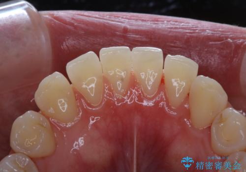 インビザラインで矯正治療を始める前にクリーニングの治療後