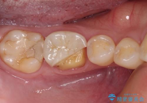 割れてしまったセラミッククラウン 強化セラミッククラウンの補綴治療の症例 治療前