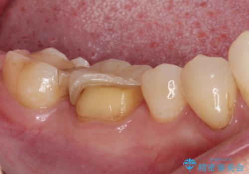 割れてしまったセラミッククラウン 強化セラミッククラウンの補綴治療の治療前