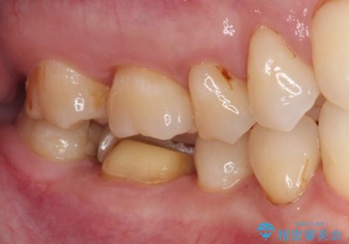 割れてしまったセラミッククラウン 強化セラミッククラウンの補綴治療の治療前