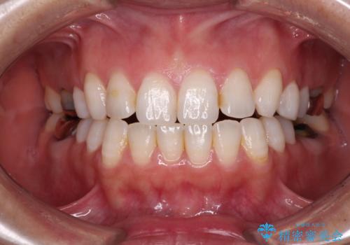 目立つ銀歯を白くしたい 奥歯のセラミック治療の治療前