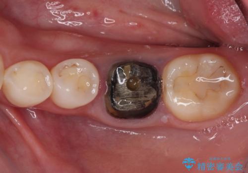 目立つ銀歯を白くしたい 奥歯のセラミック治療の治療前