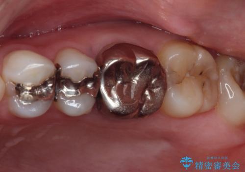 目立つ銀歯を白くしたい 奥歯のセラミック治療の治療前