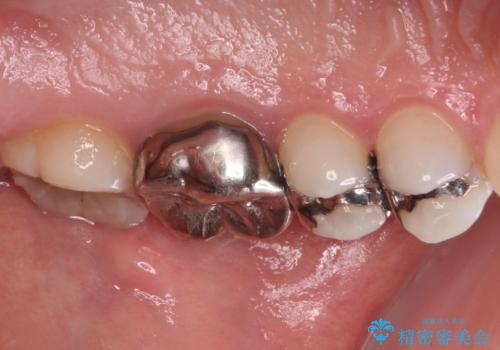 目立つ銀歯を白くしたい　奥歯のセラミック治療の治療前
