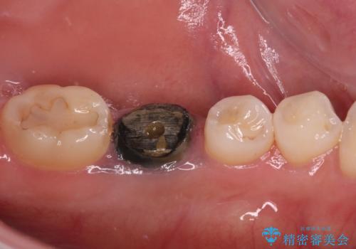 目立つ銀歯を白くしたい 奥歯のセラミック治療の治療前