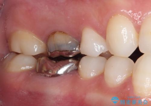 目立つ銀歯を白くしたい 奥歯のセラミック治療の治療前