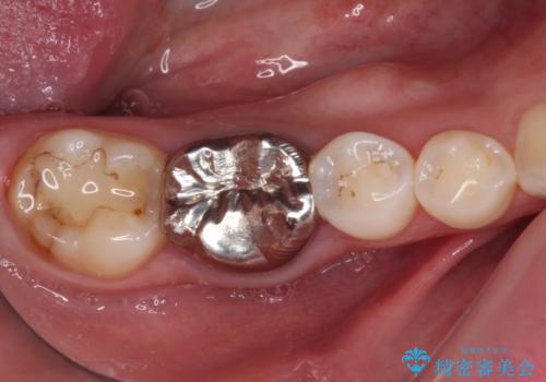 目立つ銀歯を白くしたい 奥歯のセラミック治療の治療前