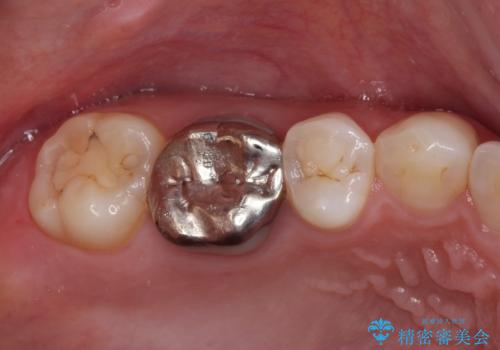 目立つ銀歯を白くしたい 奥歯のセラミック治療の治療前