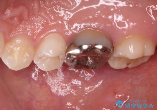 目立つ銀歯を白くしたい 奥歯のセラミック治療の治療前