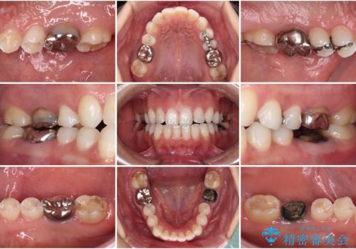 目立つ銀歯を白くしたい 奥歯のセラミック治療の症例 治療前
