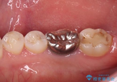 目立つ銀歯を白くしたい 奥歯のセラミック治療の治療前