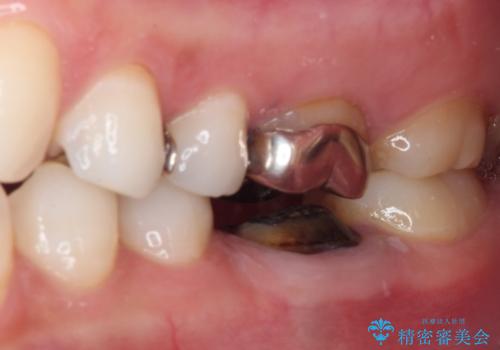 目立つ銀歯を白くしたい 奥歯のセラミック治療の治療前
