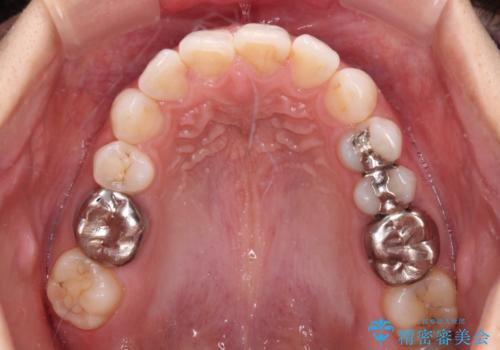 目立つ銀歯を白くしたい 奥歯のセラミック治療の治療前