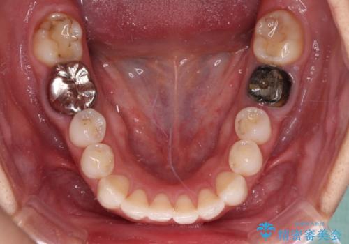 目立つ銀歯を白くしたい 奥歯のセラミック治療の治療前