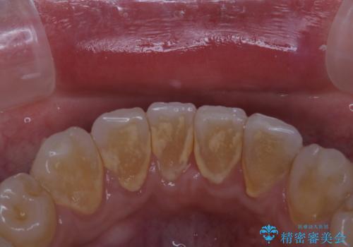 インビザライン中の歯石取りの治療前