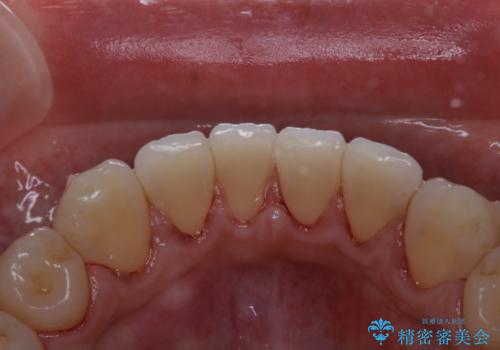 インビザライン中の歯石取りの治療後