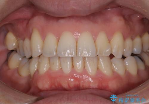 矯正治療終了時にクリーニングもの治療前